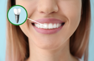 Dental Implants King Center Dental dentist in Alexandria Virginia Dr. Benson Clark 