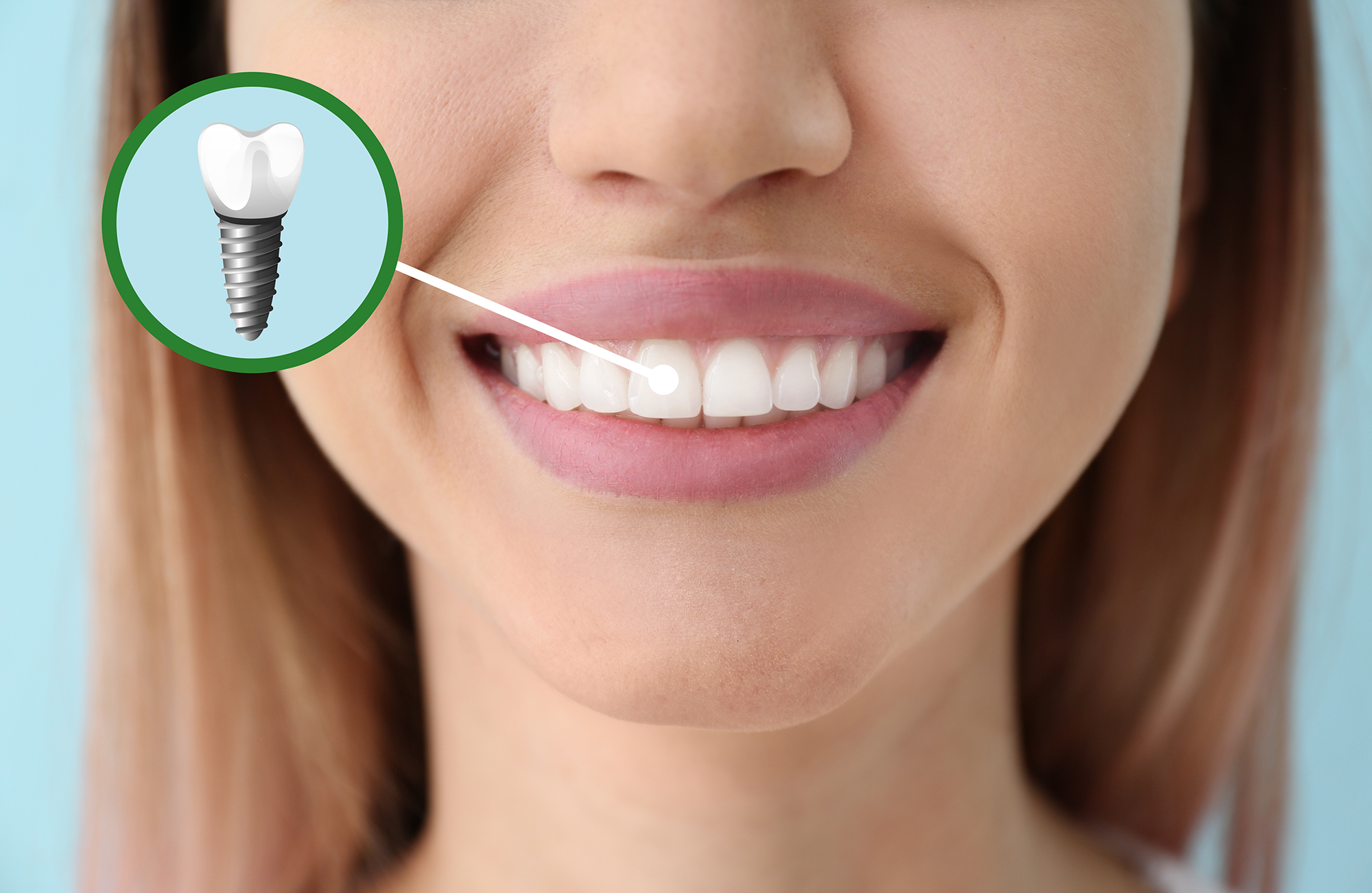 Affordable Dental Implants Near Me Muskegon Heights MI