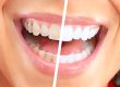 teeth whitening alexandria va Dr. Benson Clark. King Center Dental. General, Cosmetic, Restorative Dentistry. Dentist in Alexandria VA 22315