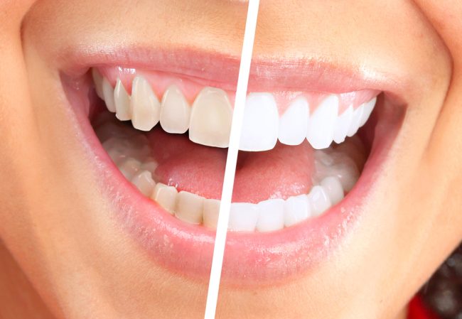 teeth whitening alexandria va Dr. Benson Clark. King Center Dental. General, Cosmetic, Restorative Dentistry. Dentist in Alexandria VA 22315 teeth whitening alexandria va Dr. Benson Clark. King Center Dental. General, Cosmetic, Restorative Dentistry. Dentist in Alexandria VA 22315