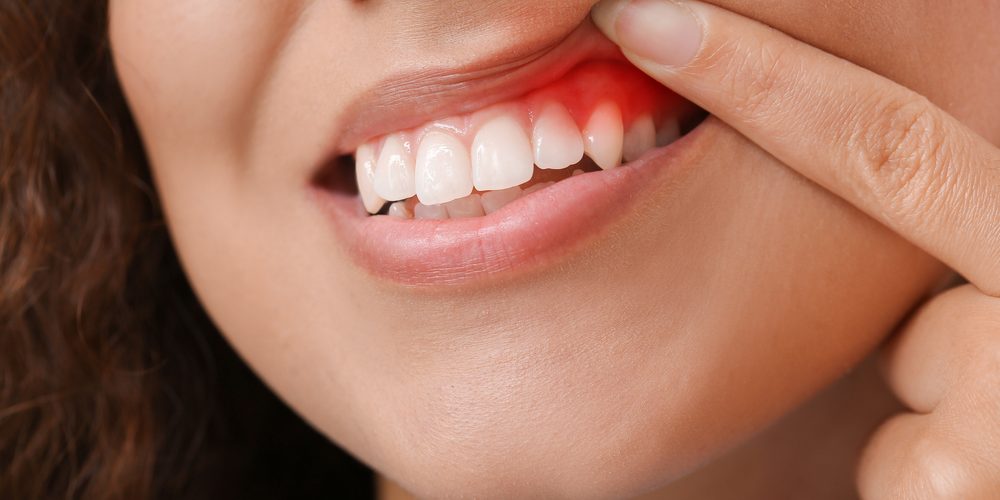 Gum Disease Treatment Alexandria VA Dr. Benson Clark. King Center Dental. General, Cosmetic, Restorative Dentistry. Dentist in Alexandria VA 22315 Gum Disease Treatment Alexandria VA Dr. Benson Clark. King Center Dental. General, Cosmetic, Restorative Dentistry. Dentist in Alexandria VA 22315