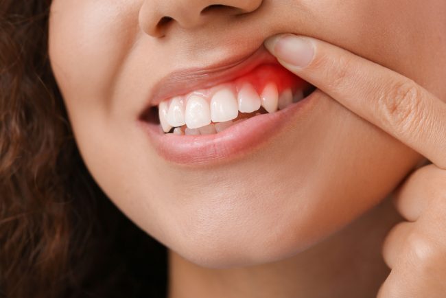 Gum Disease Treatment Alexandria VA Dr. Benson Clark. King Center Dental. General, Cosmetic, Restorative Dentistry. Dentist in Alexandria VA 22315 Gum Disease Treatment Alexandria VA Dr. Benson Clark. King Center Dental. General, Cosmetic, Restorative Dentistry. Dentist in Alexandria VA 22315