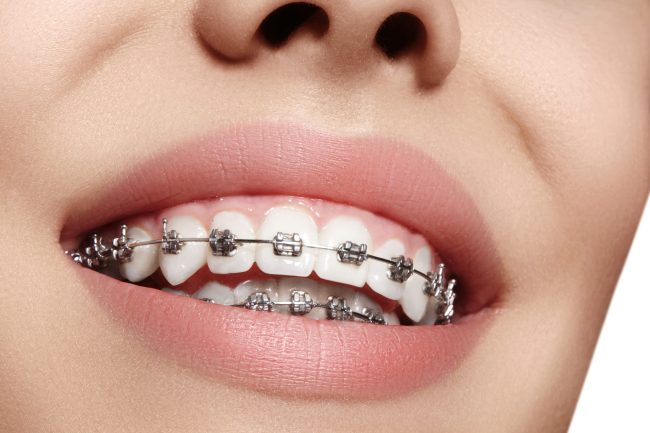 orthodontics alexandria King Center Dental. General, Cosmetic, Restorative Dentistry. Dentist in Alexandria VA 22315 orthodontics alexandria King Center Dental. General, Cosmetic, Restorative Dentistry. Dentist in Alexandria VA 22315