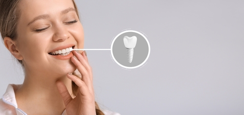 dental implants alexandria King Center Dental. General, Cosmetic, Restorative Dentistry. Dentist in Alexandria VA 22315 dental implants alexandria King Center Dental. General, Cosmetic, Restorative Dentistry. Dentist in Alexandria VA 22315
