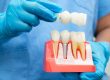 dental implants alexandria