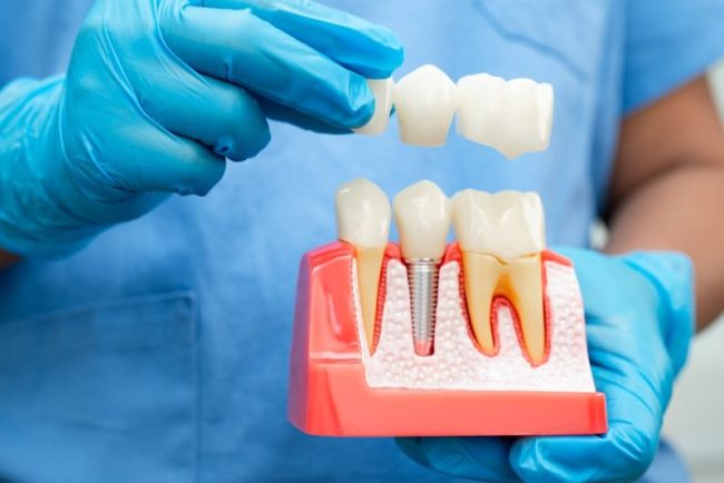 Dental,Implant,,Artificial,Tooth,Roots,Into,Jaw,,Root,Canal,Of dental implants alexandria