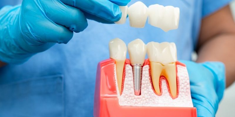 Dental,Implant,,Artificial,Tooth,Roots,Into,Jaw,,Root,Canal,Of dental implants alexandria