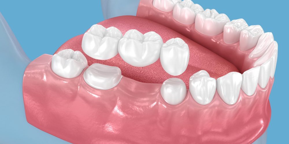 dental bridge alexandria